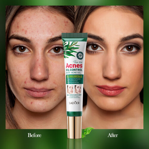 Tea tree gel for oil control and blemish removal, moisturizing and gentle, for acne marks, ideal for students.